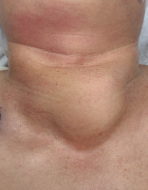 Thyroid cancer is among the most prevalent cancers in Hong Kong and the world. Precision management requires accurate disease staging and clinical risk stratification. This process is currently done manually by doctors who would have to go through a large volume of complex clinical information, which could be time consuming.